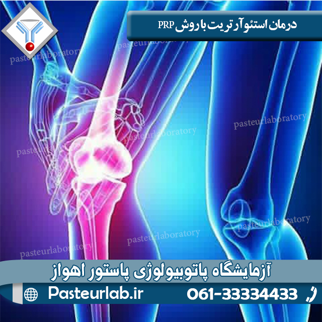 درمان استئوآرتریت با روش PRP